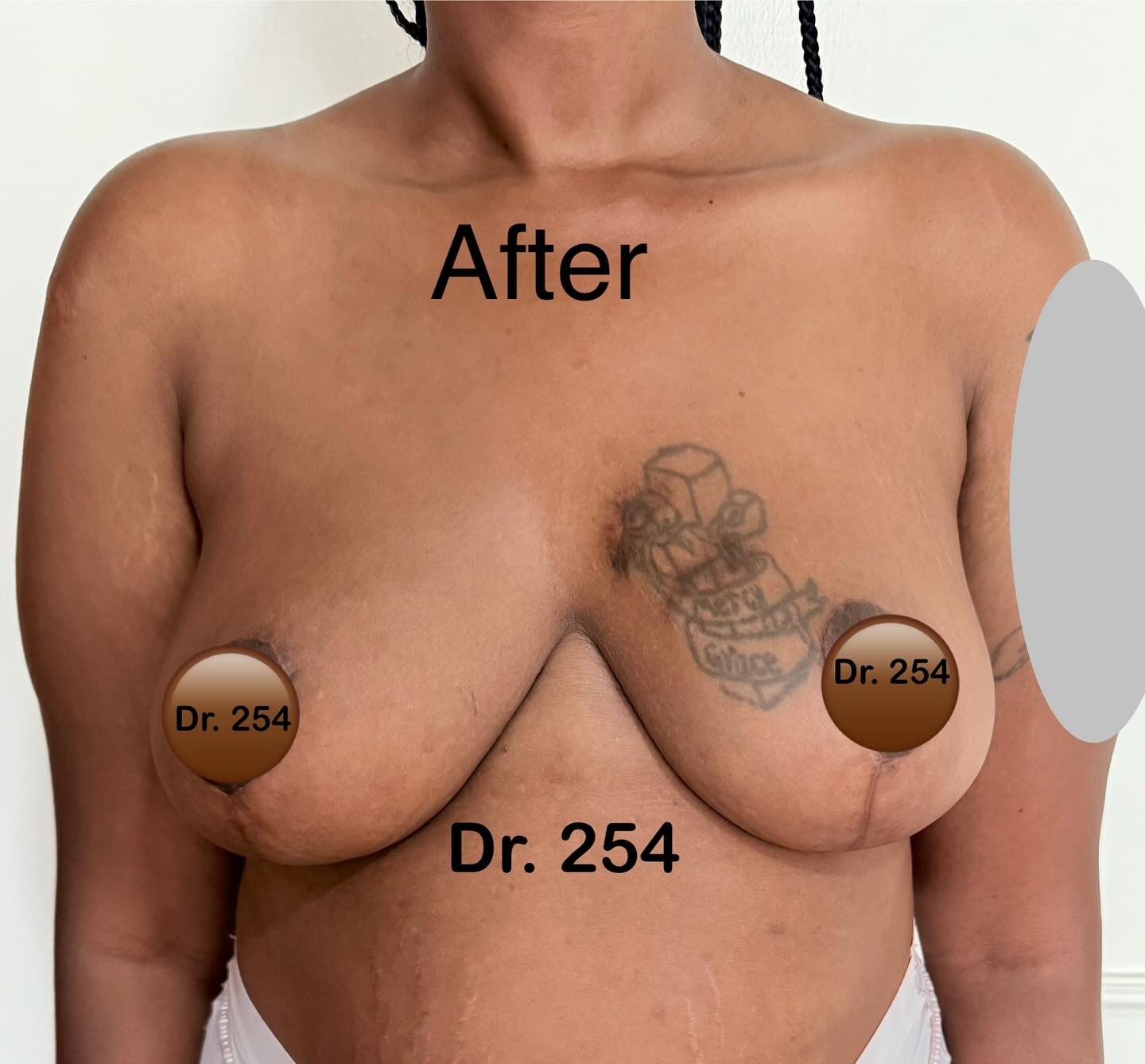 Before Breast Reduction